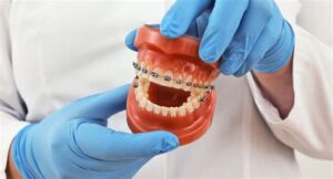 Braces Power Chain For Kids: What Parents Need To Know