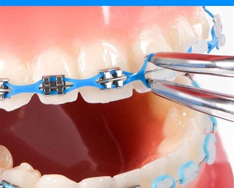 Caring For Your Teeth With Power Chain Braces