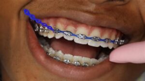 Combining Power Chains With Other Orthodontic Devices