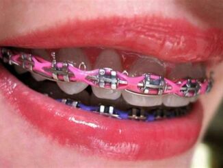 Do Power Chain Braces Hurt?