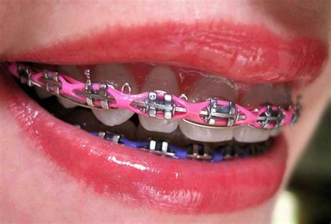 Do Power Chain Braces Hurt?