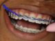 How Power Chain Braces Work To Straighten Teeth