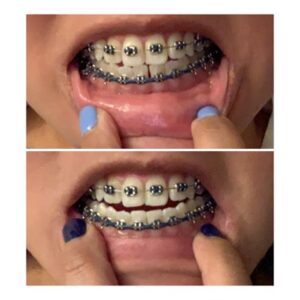 How To Choose An Orthodontist For Power Chain Braces