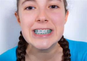 Long-Term Care For Teeth After Removing Power Chain Braces