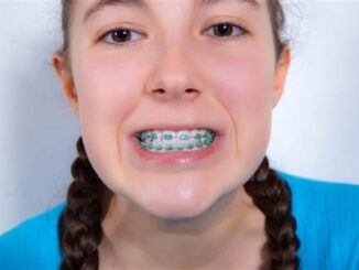 Maintaining Oral Hygiene With Power Chain Braces