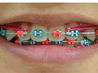 Power Chain Braces: A Comprehensive Guide For New Users