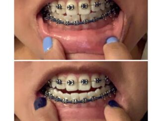Power Chains: An Effective Solution For Teeth Gaps