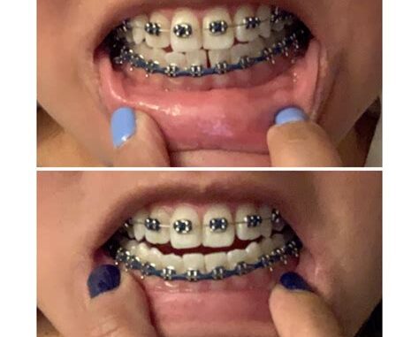 Power Chains: An Effective Solution For Teeth Gaps