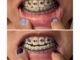 Power Chains: An Effective Solution For Teeth Gaps