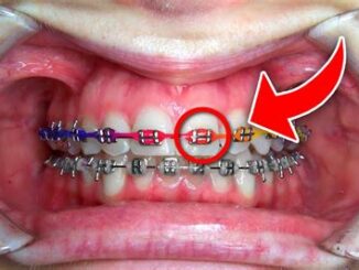 Power Chains: An Essential Tool For Orthodontists