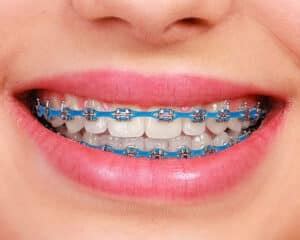 Power Chains And Their Impact On Your Smile