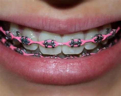 Power Chains Vs. Traditional Braces: What's The Difference?