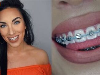 Success Stories: Before And After Power Chain Braces