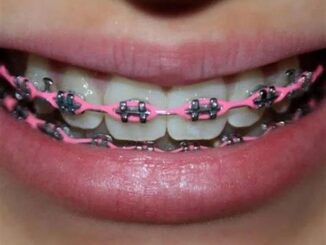 The Connection Between Power Chains And Teeth Alignment