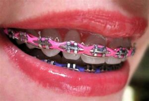 What Are Power Chains In Braces?