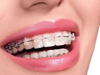 What To Expect During Your First Visit For Power Chain Braces
